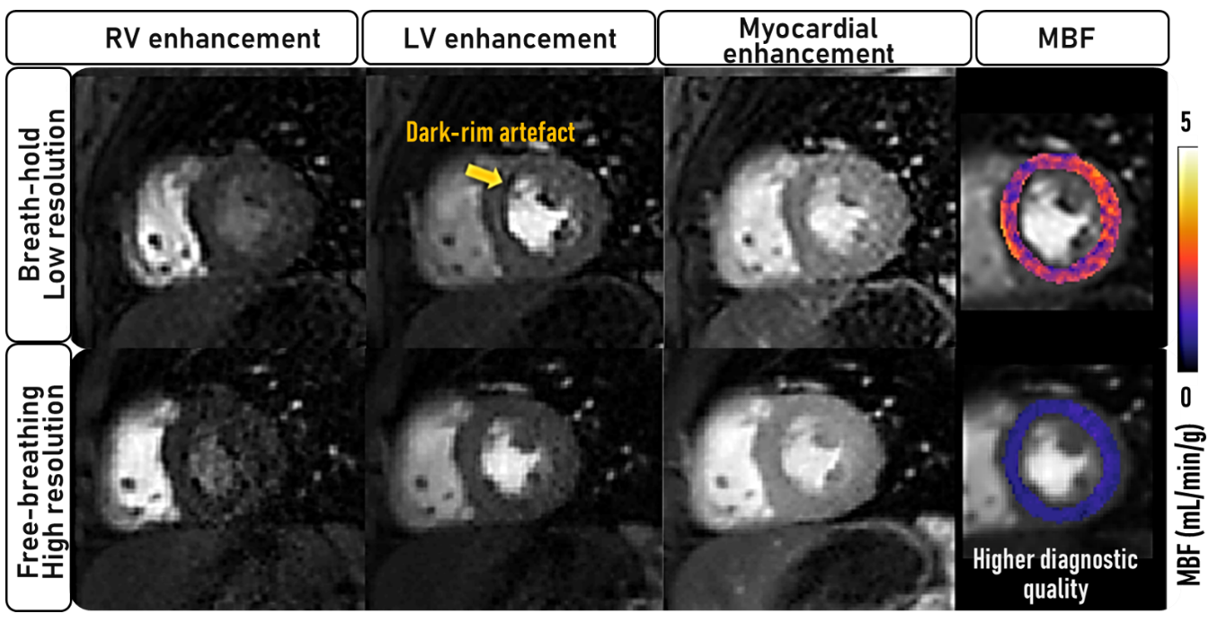 Free-breathing high-resolution quantitative myocardial perfusion CMR