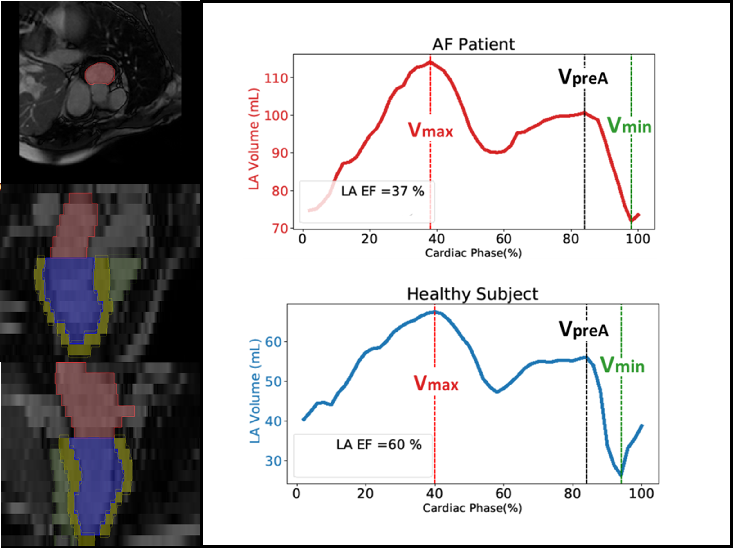  Fully automated AI-based segmentation and quantification of cardiac function